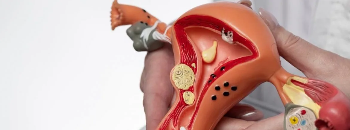 útero com miomas; cirurgia de histerectomia; retirada do útero