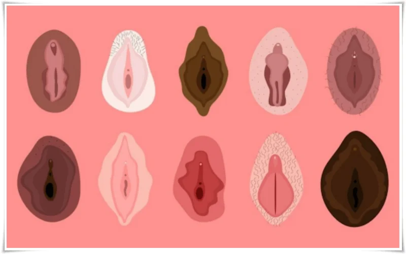 ninfoplastia; vulva; hipertrofia dos lábios