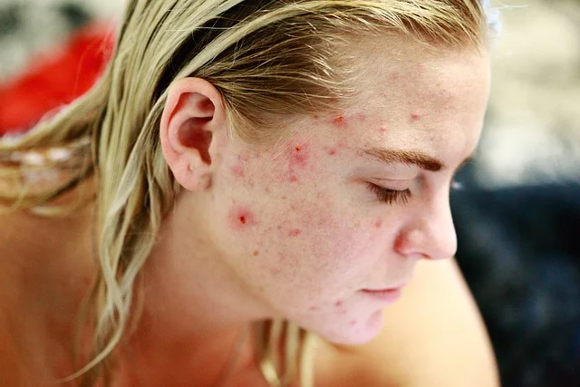 mulher jovem com acne no rosto